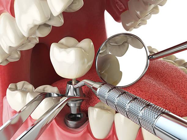 Best Emergency Tooth Extraction in Lyons, IL